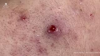 Big Cystic Acne Blackheads Extraction Blackheads & Milia, Whiteheads Removal Pimple Popping