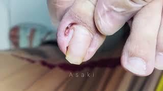 Cut Big Dirty Ingrown Toenail 497 剪大脏向内生长脚趾甲 #health #shorts