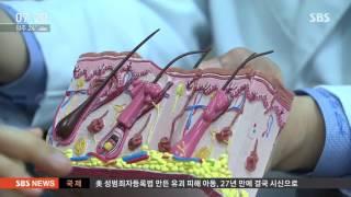 사춘기 보다 심한 성인 여드름…초기 치료 중요 / SBS