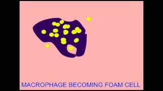 HEART DISEASE: FOAM CELLS.avi