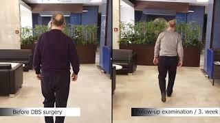 Change of Parkinson Patient Mirzokhid Obidov with DBS Treatment | Doç. Dr. Ali ZIRH