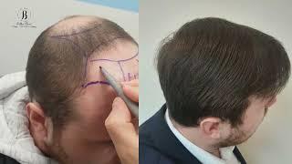 Hair transplant before and after / пересадка волос до и после