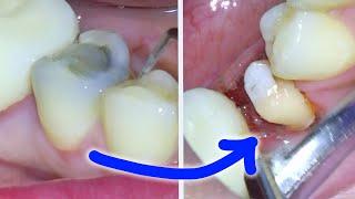 Full Dental Crown Procedure! After a Root Canal On a Molar! Permanent & Temporary Tooth Cap Guide