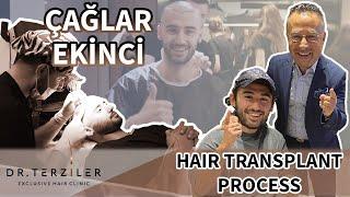 Çağlar Ekinci's Hair Transplant Process With A Robotic DHI #hairtransplant #roboticdhi #çağlarekinci