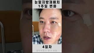 #눈밑지 #눈밑지방재배치