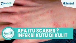 Apa itu Scabies? Faktor Risiko dan Cara Atasi Infeksi Kutu pada Kulit