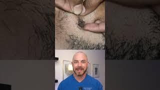 Derm reacts to INSANELY hairy extraction! #dermreacts #doctorreacts #extraction