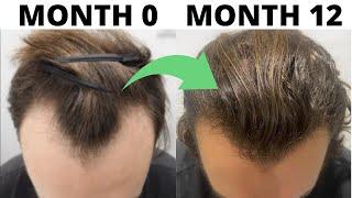 SEVERE Hair Loss To EPIC Hair Growth (Subscriber REVERSES Male Pattern Baldness In 1 Year)