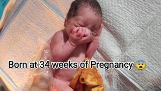 Born Early || Premature newborn baby with Congenital anomalies just after birth #love