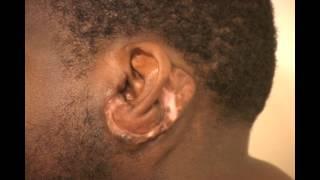 Follow up, Massive Ear Keloids Treated by Keloid Specialist Dr. Michael H. Tirgan.