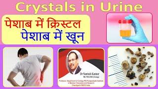 Crystals in urine. पेशाब में खून | पेशाब में क्रिस्टल. Dr.(Prof)Santosh Kumar PGI.