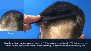 FUE Hair Transplant Case Study   Dr  Scott Boden