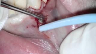 Soft Tissue Biopsy