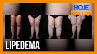 Você e o Doutor: saiba mais sobre o lipedema