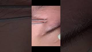 빠져드네~ #blackheads #blackheadcaique #여드름 #피부 #피부관리