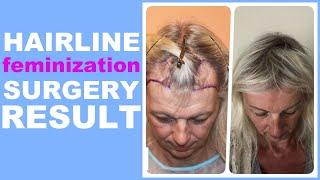 Dr.BISANGA, HAIRLINE FEMINIZATION SURGERY. POST YEAR UPDATE.