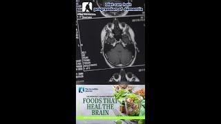 Unlock the Secret to Brain Health with Every Bite!