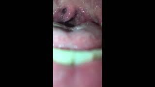 My tonsils are bigger | Mouth and Uvula