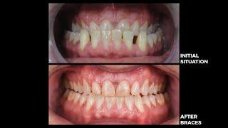 Smile Transformation with veneers