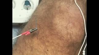 Acupuncture for Relief of Knee Pain