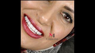 Smile line rehabilitation with laminate veneers