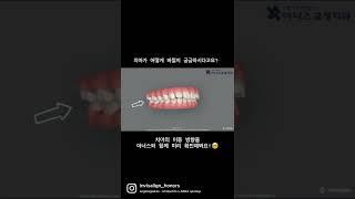 Clin check 로 교정치료 전에 치아의 이동방향 미리 확인해보자 