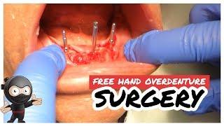 Freehand Overdenture Surgery How to lineup your angles without a guide