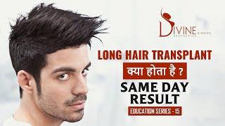 Session 15 - Long Hair Transplant - Long Hair Transplant Technique | Dr. Amit Gupta