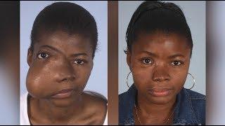 Maxillofacial Surgery: Changing Faces, Changing Lives - Kadiatu's Story