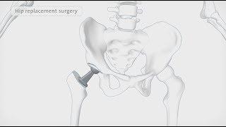 How a hip replacement is performed | Spire Healthcare