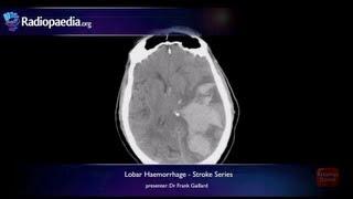 Stroke: Lobar haemorrhage - radiology video tutorial (MRI, CT)