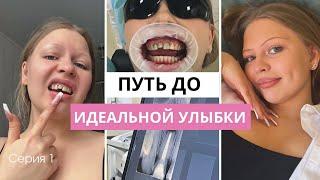 Серия 1 / киста, лечение, виниры за 400К⁉️