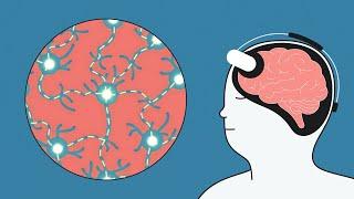 What is tDCS