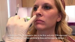 Juvederm Volbella | Total Dermatology