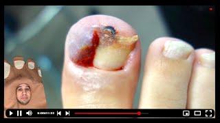 SUPER BAD OVERGROWN TOENAIL #toebroclip