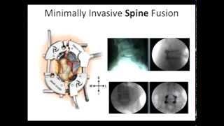 Shasta Orthopaedics - Dr  Brad Jones, Spinal Stenosis Procedures