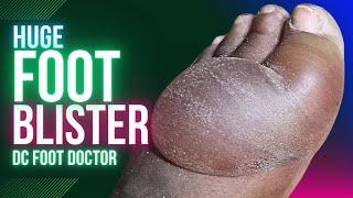 Enormous Foot Blister: Diabetic Peripheral Neuropathy and Thermal Injury