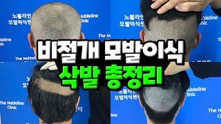 [ENG] 3분 만에 보는 비절개 모발이식 삭발 총정리_A total summary of FUE hair transplant shaving in 3 minutes