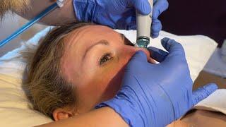 HydraFacial review: See the treatment + results up close!