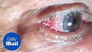 GRAPHIC: Moment 15cm long worm is removed from mans eye