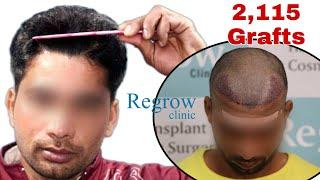 Best Hair Transplant Result 2021 || NW Grade II || 2,115 Grafts ||  @Regrow Clinic ​