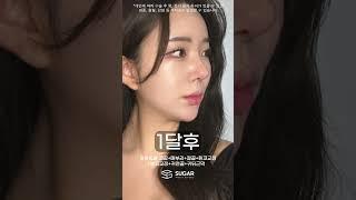 슈가성형외과 수술전 ~ 3달차까지 변화과정 #성형외과 #코성형 #의사
