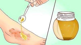 Put Raw Honey On Burns And Wounds, THIS Will Happen