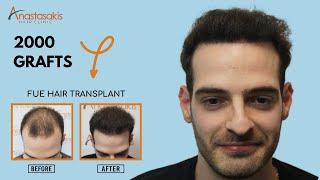  12-Month Post-Hair Transplant Check-Up | 2000 Grafts FUE | Anastasakis Hair Clinic  Case #294