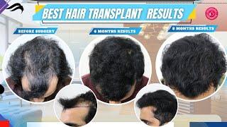 Hair Transplant In Tirupati | Best Cost Clinic Results & Surgeon Of Hair Transplant In Tirupati