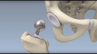 Hip Surgery Overview - Mayo Clinic