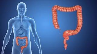 What is Colorectal Cancer?