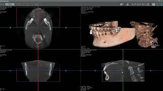 Adding Implant Crowns with the X-era Dental Cone Beam From ImageWorks
