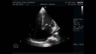 Dr khaled karem 14 nov 2023 mitral valve diseases