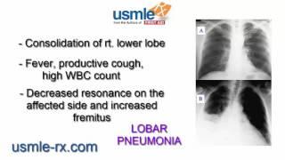 USMLE-Rx: Lobar pneumonia